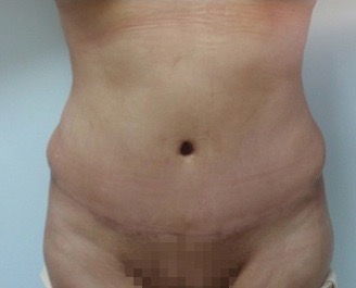 Abdomen-2